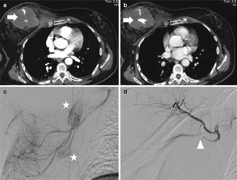 Traumatic Chest Wall Injuries | Radiology Key