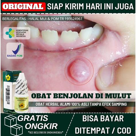 Jual Obat Herbal Pengempis Benjolan Di Mulut And Lidah 100 Alami Obat Mukokel Herbal Tetes