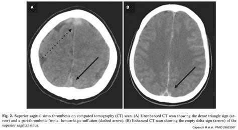 Cerebral Venous Thrombosis Emcrit Project