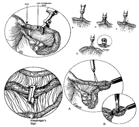 Laparoscopy In Gynecology How Why When