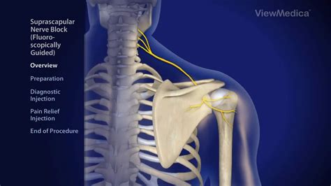 Suprascapular Nerve Block Fluoroscopically Guided Pain Wellness