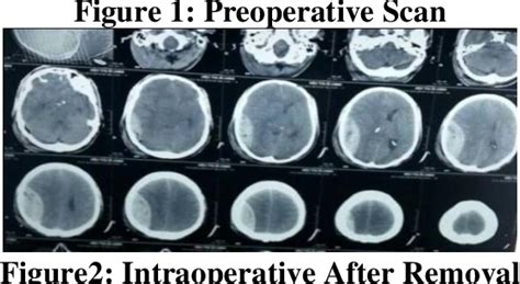 Figure 1 From Surgical Evacuation Extradural Hematoma Under Local Anesthesia Semantic Scholar