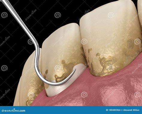 Oral Hygiene Scaling And Root Planing Conventional Periodontal Therapy