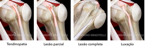 Lesões do bíceps no ombro lesão do tendão da cabeça longa do bíceps