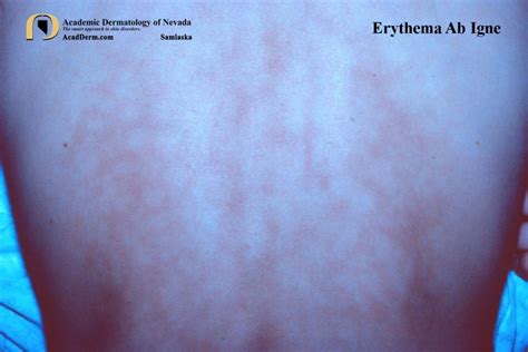 Erythema Ab Igne: Stop Using The Heating Pad... - Academic Dermatology ...