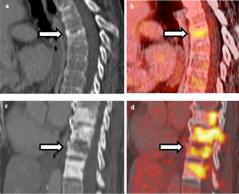 Comparison Between Vertebral Body Insufficiency And Pathological