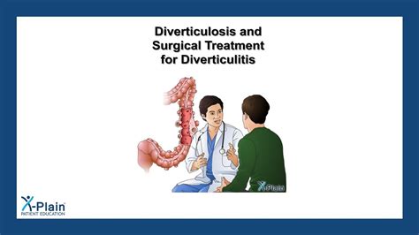 Diverticulosis and Surgical Treatment for Diverticulitis - YouTube