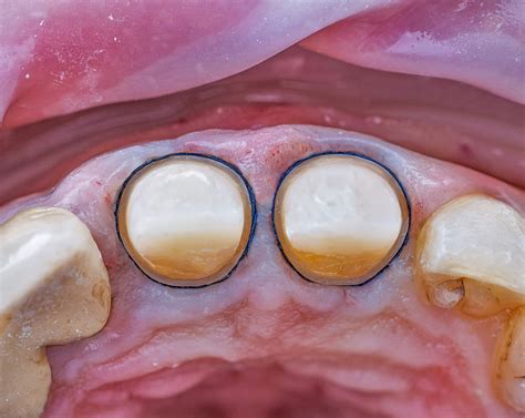 Management of Structurally Compromised Teeth - MyZerodonto
