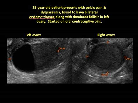 Teratoma Ovary Ultrasound