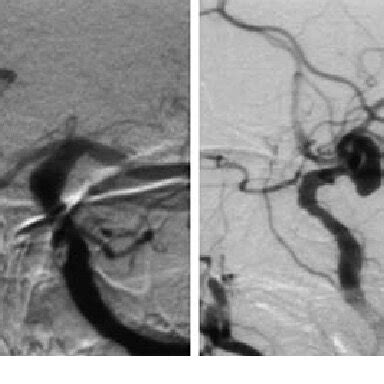 Right Internal Carotid Angiograms In Anteroposterior View Left