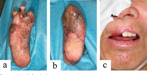 A Case Of Symmetrical Peripheral Gangrene Secondary To Liver