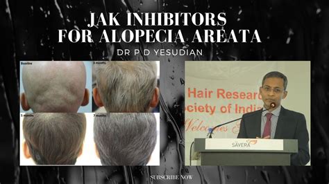 Jak Inhibitors For Alopecia Areata Youtube