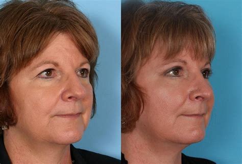 Patient 376062 Eyelid Surgery Blepharoplasty Before And After Photos Buckingham Center For