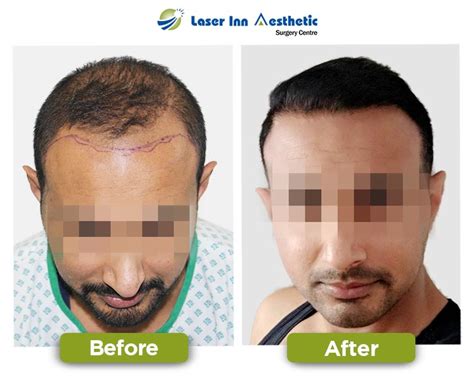 Laser Inn Best Hair Transplant Results Best Fue Hair Transplant