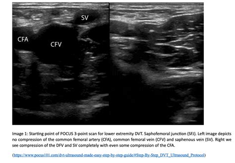 Dvt In 1 2 3 — Usf Emergency Medicine