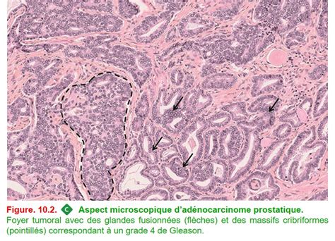 Société Française de Pathologie IV Pathologie urologique