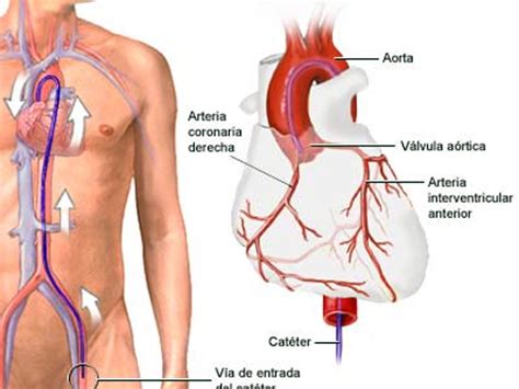 Termo Coron Rio Angiografia Infraredmed