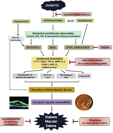 Figure 5 From Diabetic Macular Edema Pathophysiology And Novel