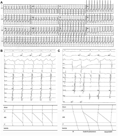 A Electrocardiogram During Narrow Complex Tachycardia B Intracardiac