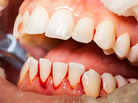 Periodontia Got Odontologia Em Taguatinga