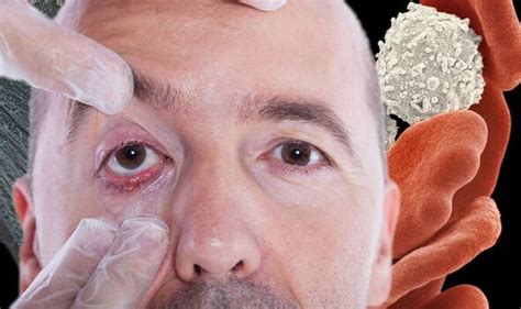 Cancer: Symptoms may include pallor inside the lower eyelid | Express.co.uk