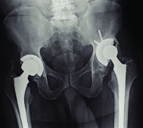 Acetabular Component Migration Secondary To Aseptic Loosening With A Download Scientific