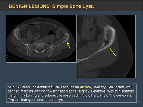 Figure 4 From Pelvic Bone Lesions A Radiologic Pictorial Review