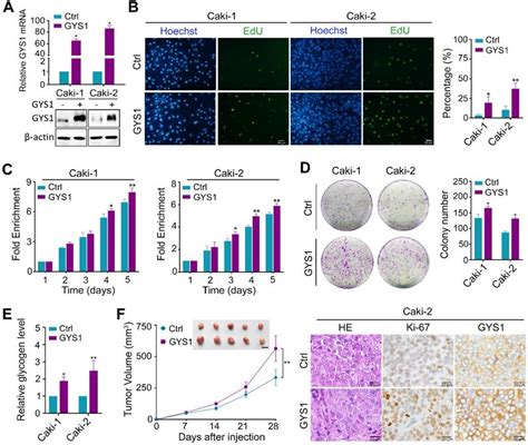 Gys Induces Glycogen Accumulation And Promotes Tumor Progression Via