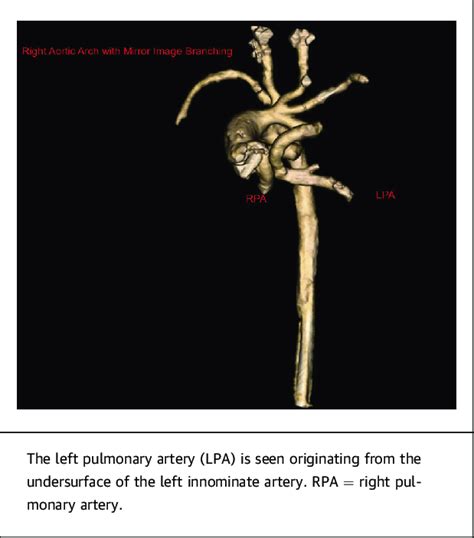 Volume Rendered Computed Tomographic Reconstruction Showing A Right Download Scientific Diagram