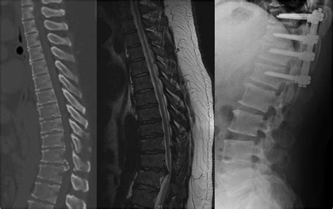 Development And Validation Of A Novel Thoracic Spinal Stenosis Surgical