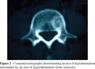 SciELO Brasil Treatment Of Osteoid Osteoma In The Vertebral Body Of