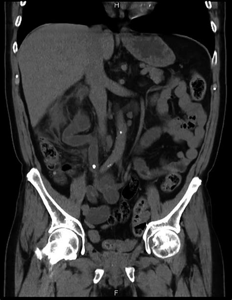 cm distal ureteral stone   ureteroileal anastomosis