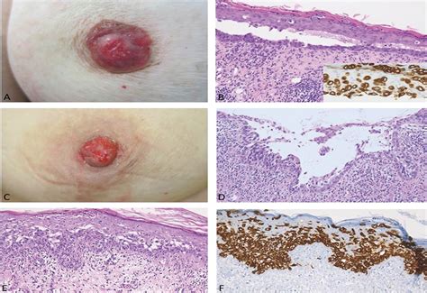 Acantholysis In Mammary Paget Disease The American Journal Of