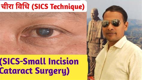 चीरा विधि Sics Small Incision Cataract Surgeryसे मोतियाबिंद ऑपरेशन