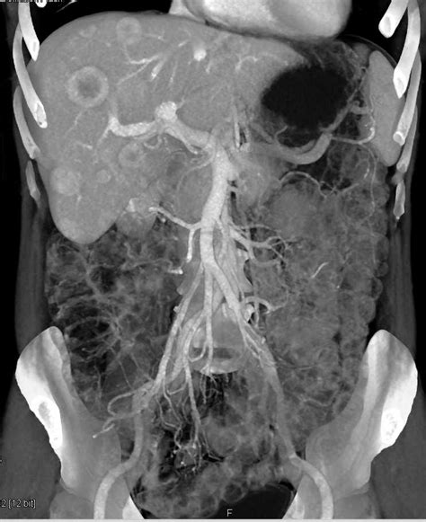 Metastatic Carcinoid Tumor To The Liver Liver Case Studies Ctisus