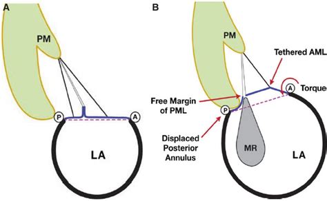 Atrial Functional Mitral Regurgitation Circulation Cardiovascular Imaging