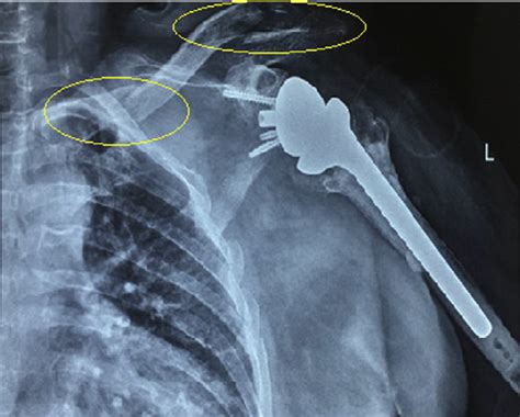 X Ray Radiograph Of The Left Clavicle And Shoulder Joint Showing A