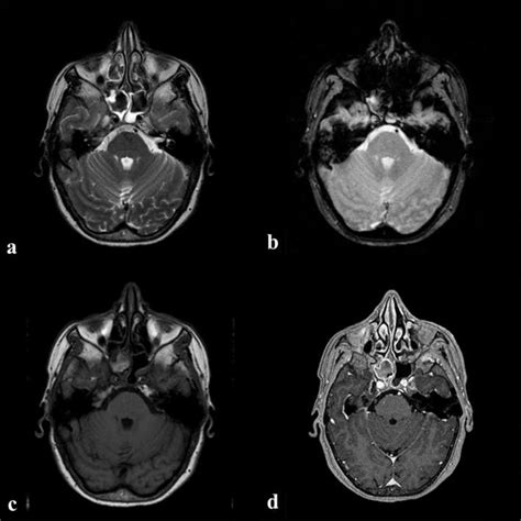 Isolated Fungus Ball In Sphenoid Sinus Tips And Pitfalls Of T1 Hyperintense Lesions Pmc