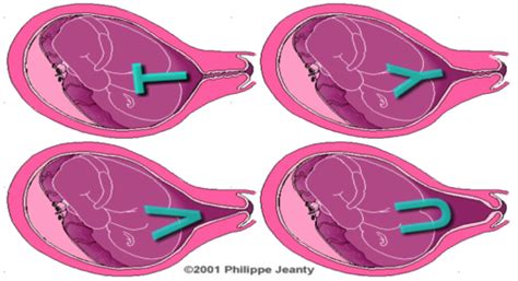 NSC 396 Exam 2 Antepartum Part 2 Flashcards Quizlet