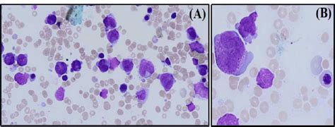 Aandb Bone Marrow Aspirate Exhibiting Unusually Large And Download Scientific Diagram