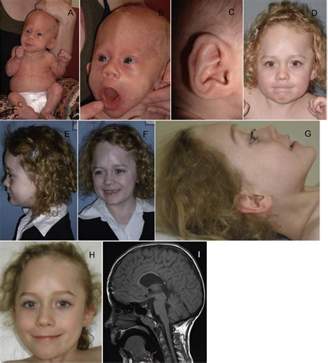 Series Of Clinical Photos Showing Progression Of Craniofacial Features