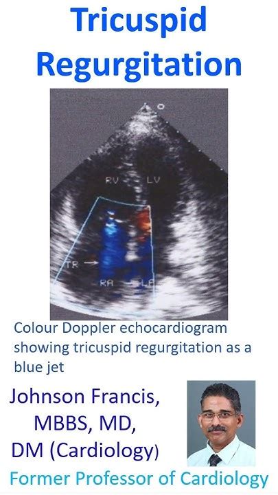 Tricuspid Regurgitation Youtube