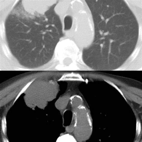 Sarcomatoid Carcinoma Appearing As A Large Nodular Lesion Of The Right