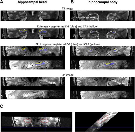 Example Segmentation Of Hippocampal Subfield DG Blue And CA3 Yellow