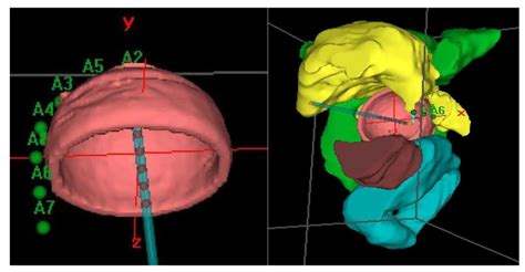 Clinical Target Volume CTV And Organs At Risk OAR Delineation