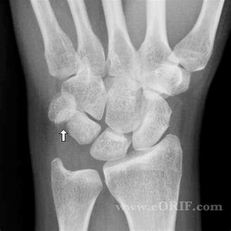 Triquetral Fracture S62.113A 814.03 | eORIF