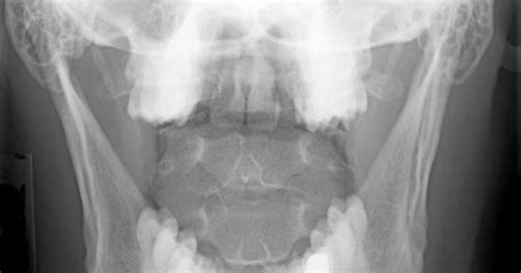 Dens Fracture Treatment | Dens Bone Fracture Surgery