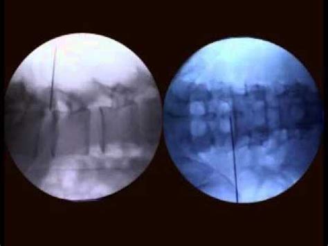 PLDD Descompressão Discal Percutânea por Laser IN GOOD HANDS