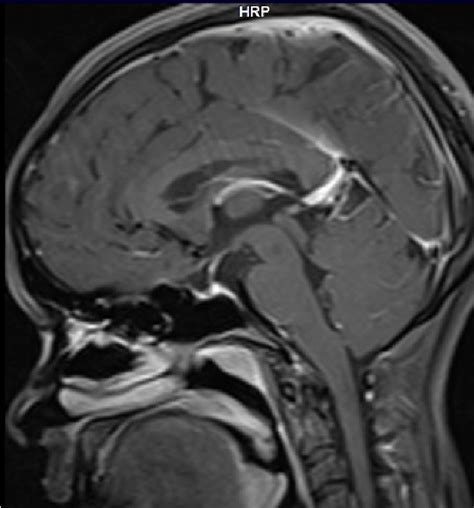 Post Gadolinium T1 Weighted Magnetic Resonance Image Of Pituitary In