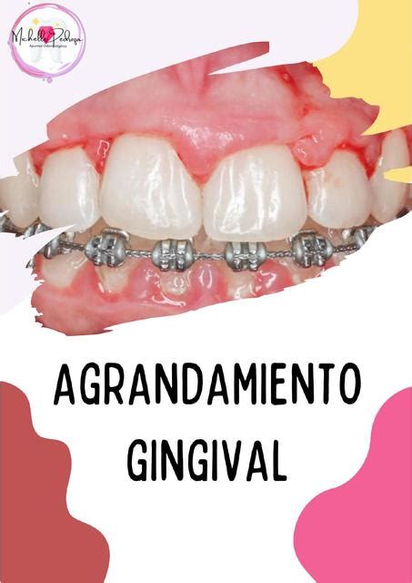 Agrandamiento Gingival Michelle Pedroza UDocz